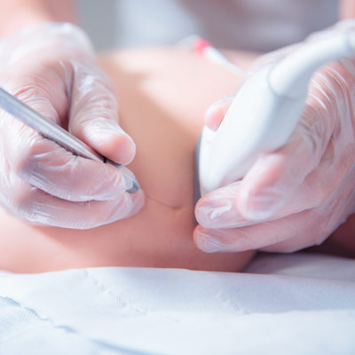 Ultraschalltherapie